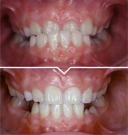 Class-III-Correction