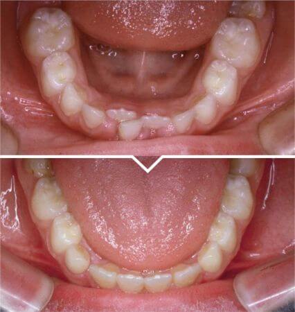 Lower-Crowding-Correction