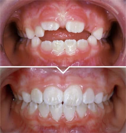 Open-Bite-Correction