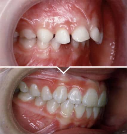 Underdeveloped-Jaw-Correction