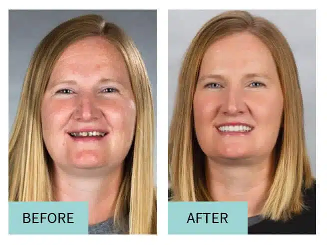 Before After Cosmetic Dentistry in Sioux Falls