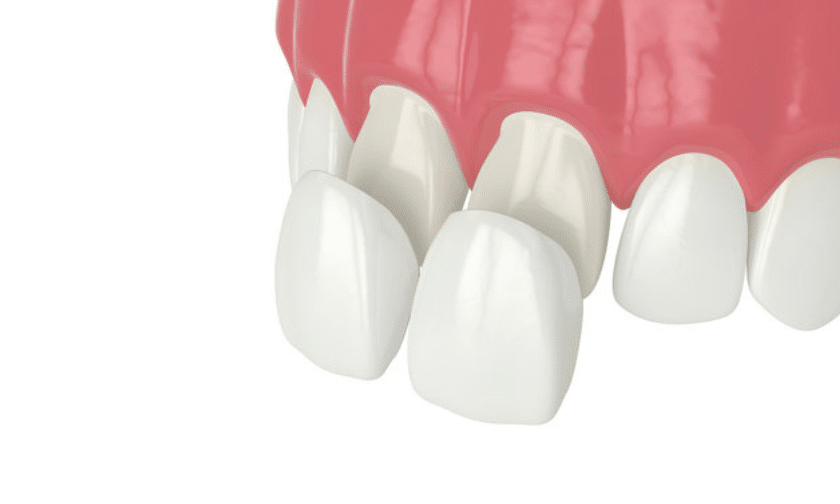 Dental Veneers image on Designer Dentistry