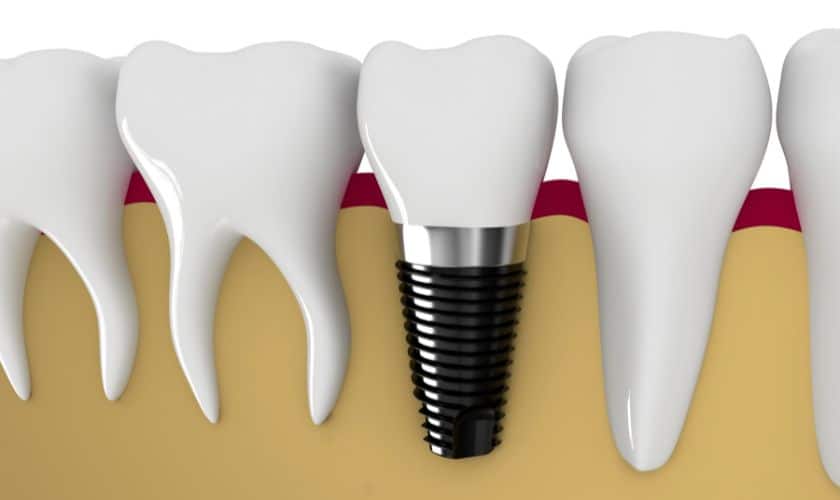 Dental implants Sioux Falls - Designer Dentistry