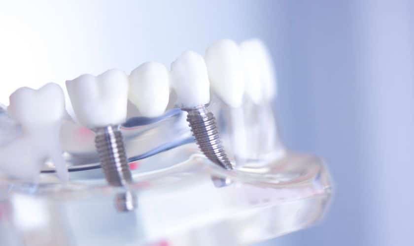 Implant Dentist Sioux Falls - Designer Dentistry