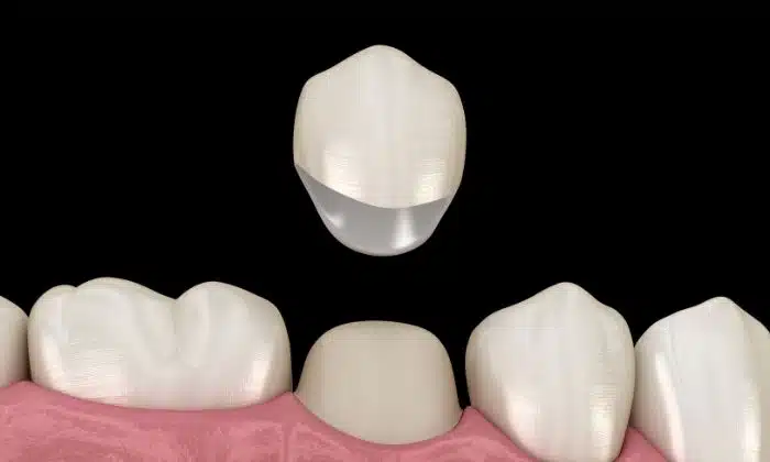 Prolonging The Lifespan of Dental Crowns