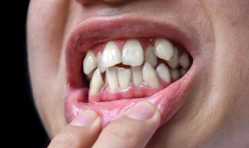 Treatment Options for Bad Teeth
