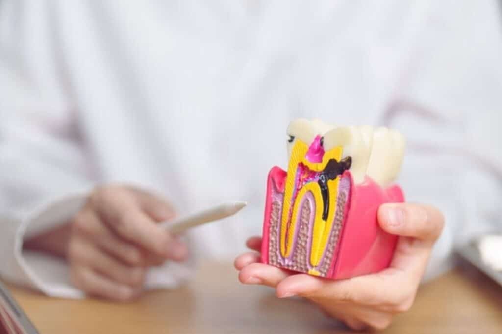 tooth decay treatment by Dentist sioux falls sd