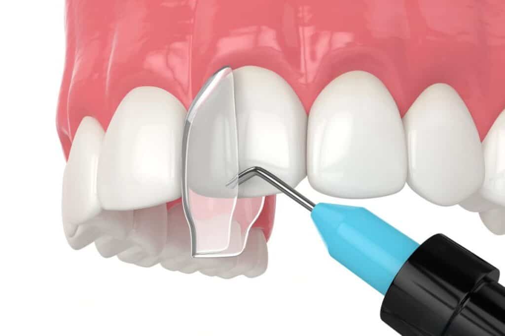 Does Tooth Bonding Hurt