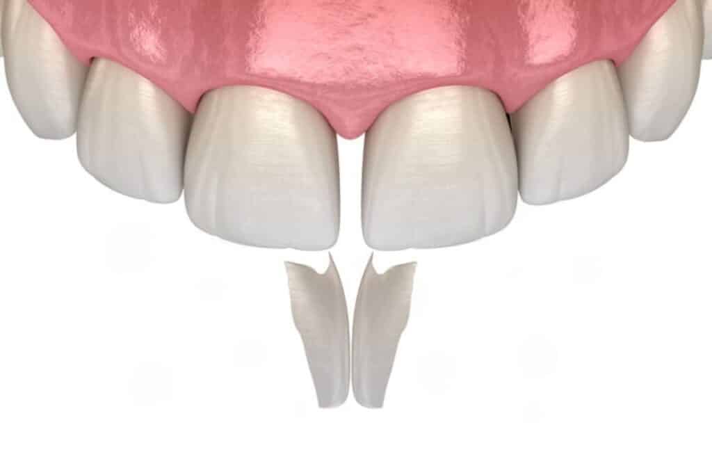 Can Tooth Bonding Be Removed
